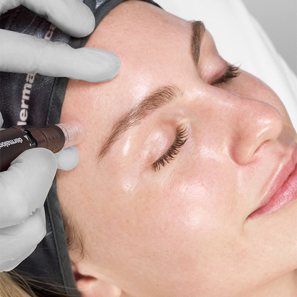 Microneedling Behandlung